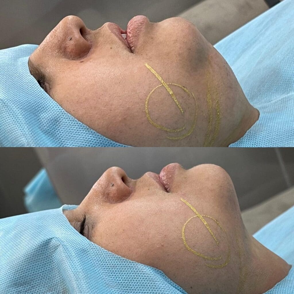 Especialista esclarece dúvidas sobre a lipo de papada