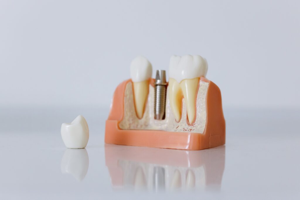 Vitamina D e Implantes: O Exame que Ninguém Pede Antes da Cirurgia