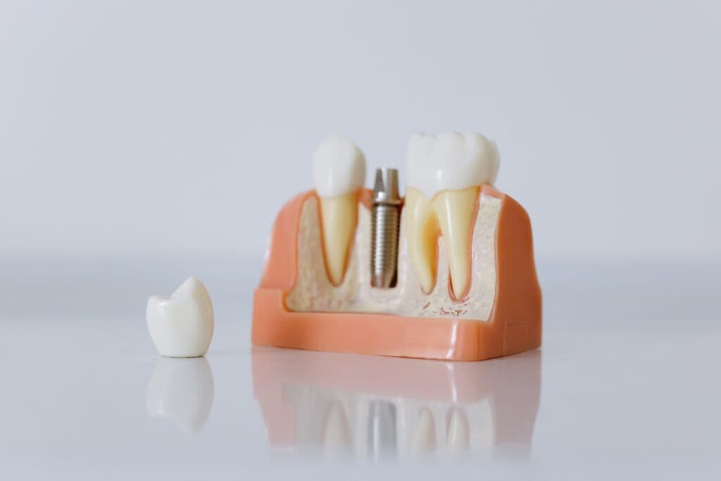 Vitamina D e Implantes: O Exame que Ninguém Pede Antes da Cirurgia