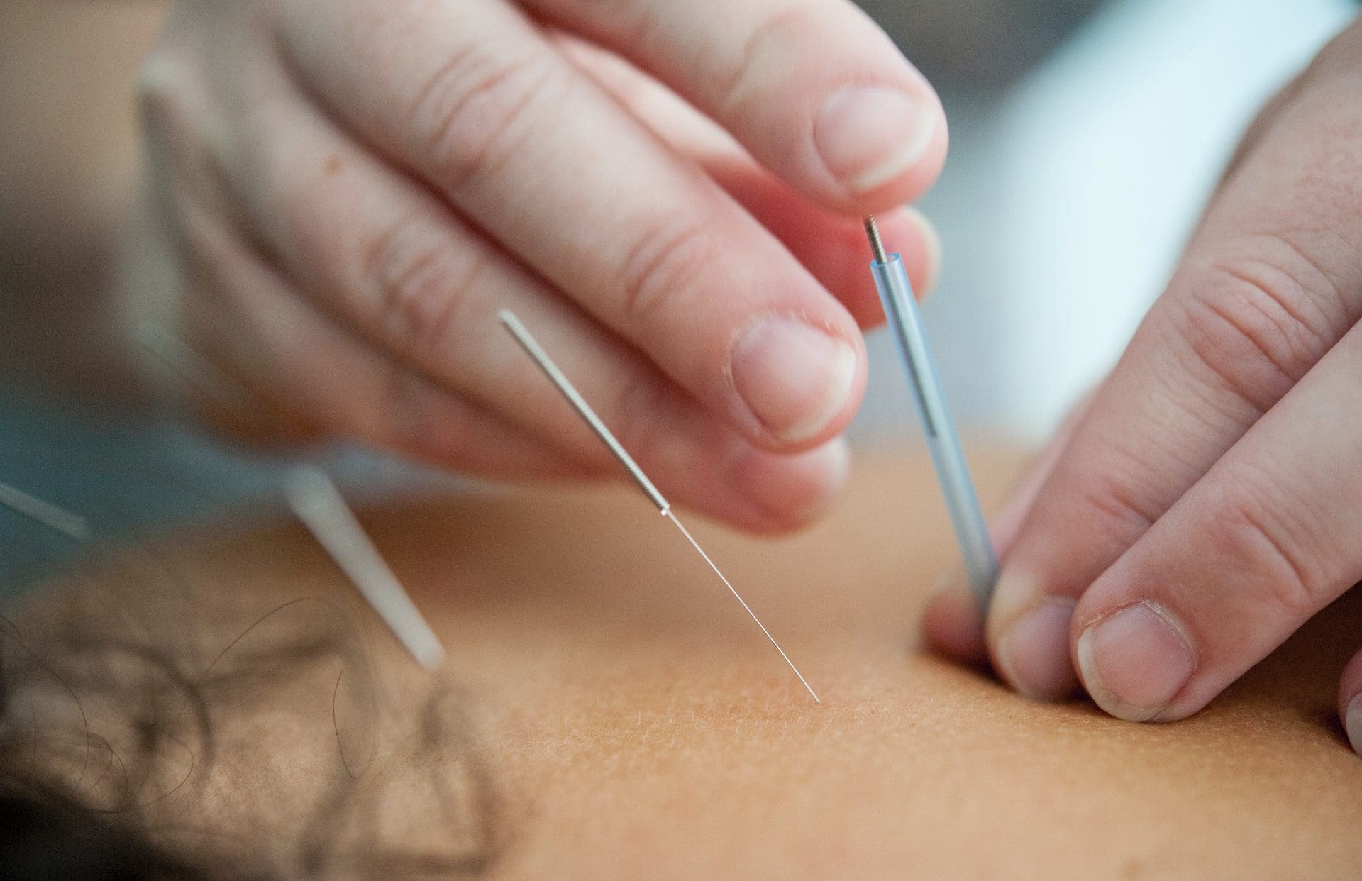 esteticista pode fazer acupuntura acupuntura quem pode exercer 2023 curso de acupuntura reconhecido pelo mec pós-graduação em acupuntura massoterapeuta pode fazer acupuntura técnico de enfermagem pode fazer curso de acupuntura acupunturista é médico quem não pode fazer acupuntura